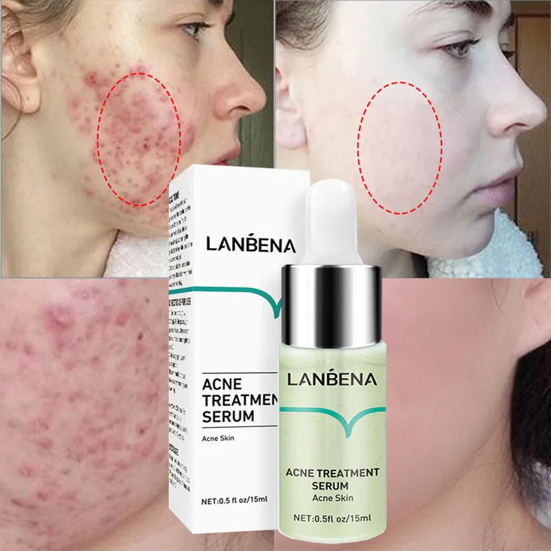 Effective Acne Removal Serum Salicylic Acid Anti-Acne Face Essence Fade Acne Scar Shrink Pores Oil Control Moisturizing Care