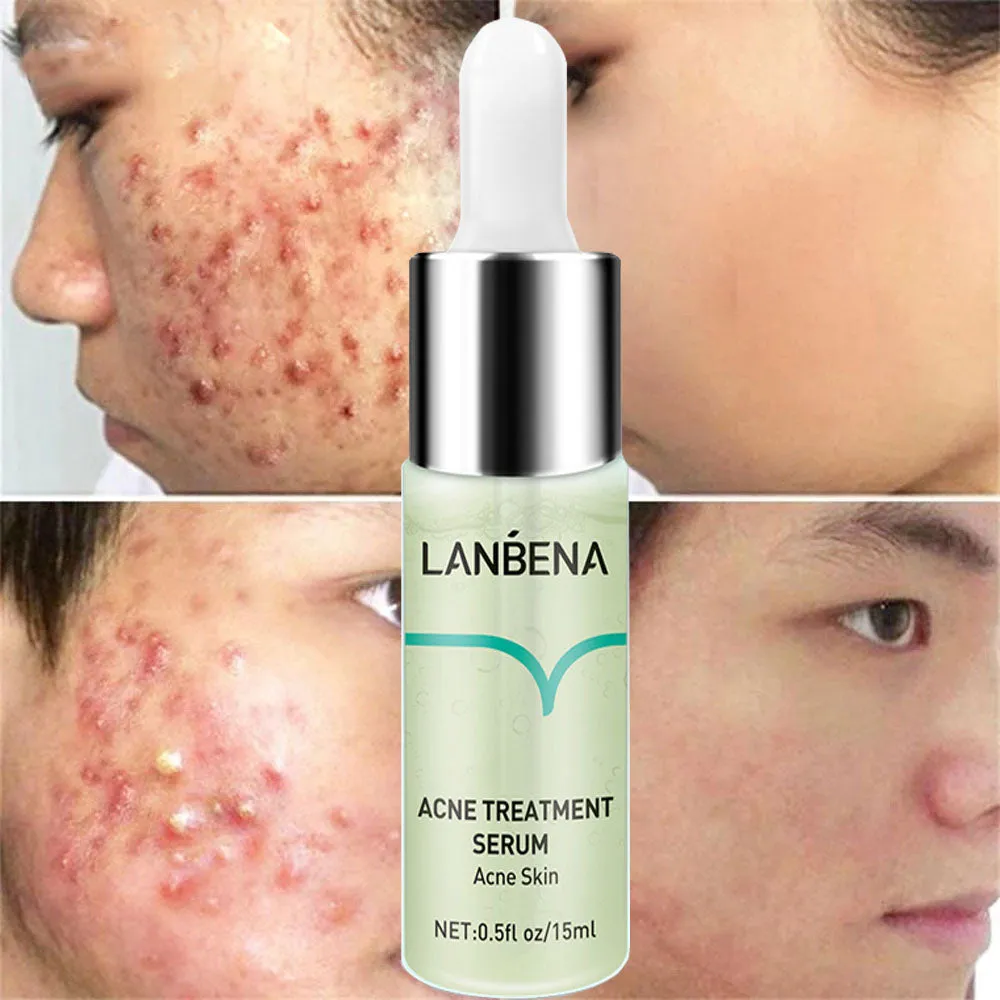 Effective Acne Removal Serum Salicylic Acid Anti-Acne Face Essence Fade Acne Scar Shrink Pores Oil Control Moisturizing Care