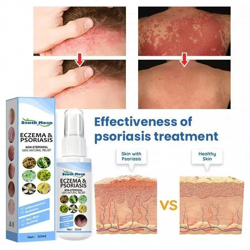 Herbal Psoriasis Relief Spray